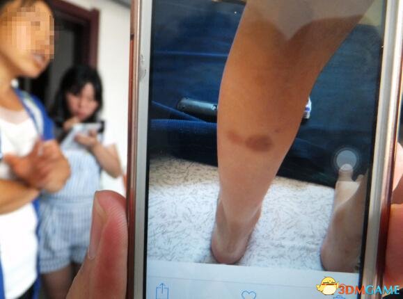 女童母亲向记者展示自己拍摄的照片，6月23日时小红的左腿上有明显的掐痕