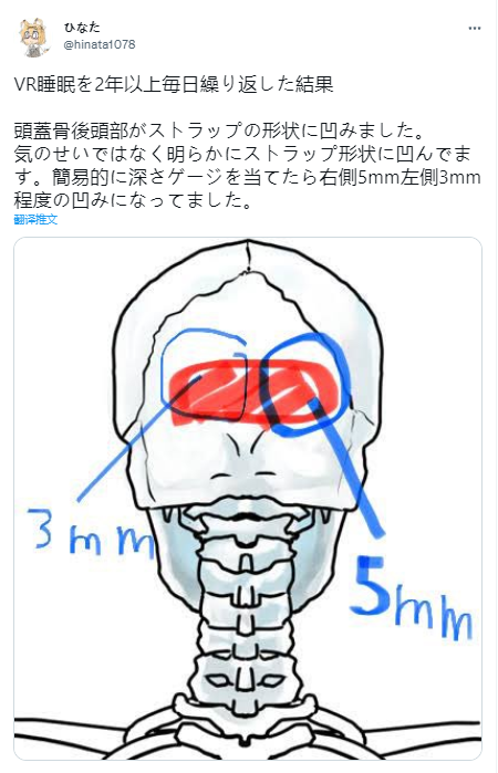 日本网友连续两年头戴VR头盔睡觉 导致后脑勺凹陷