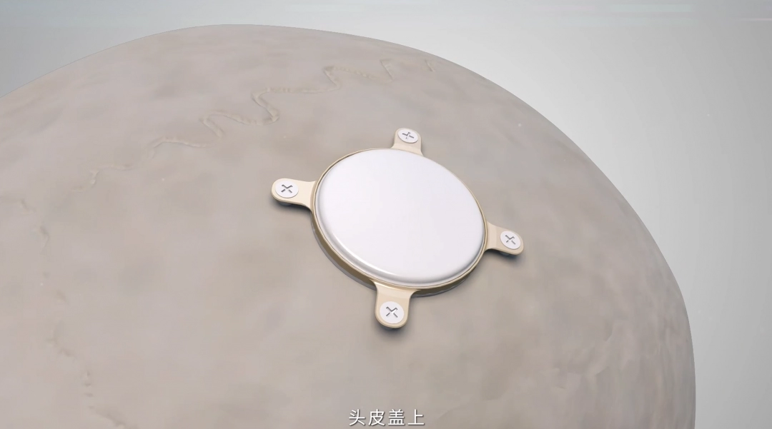 意念控制游戲？我國開展首例侵入式腦機(jī)接口臨床試驗(yàn)